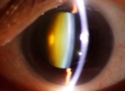 Καταρράκτηςς